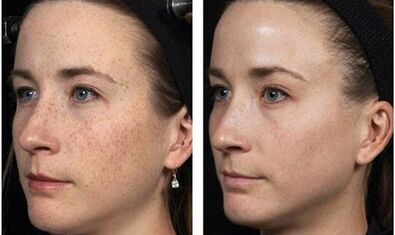 Rexuvenecemento facial fraccionado antes e despois de fotos